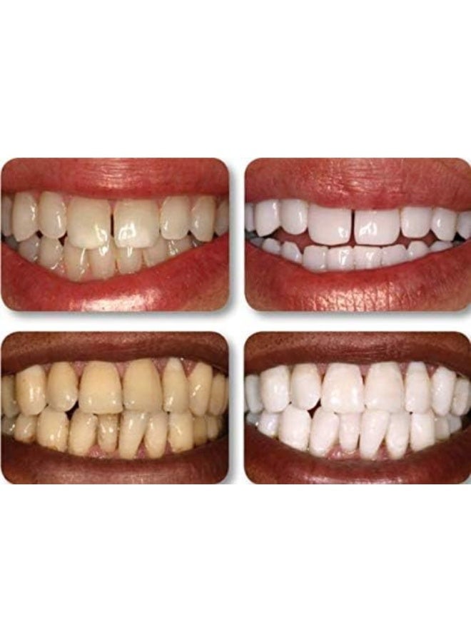 Ultra White 22% Teeth Whitening Gel Large 5 Tubes 3.8 ml of Gel - Image 3